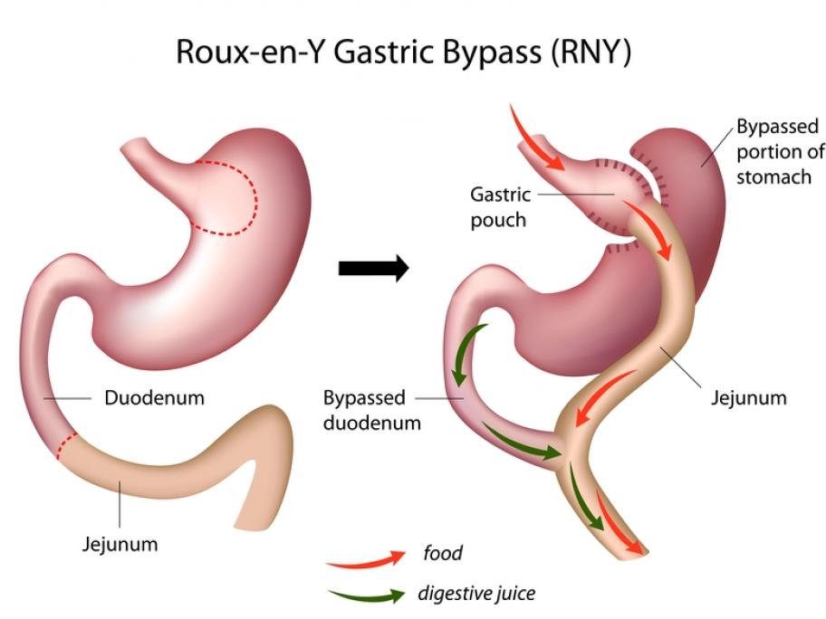 gastric bypass