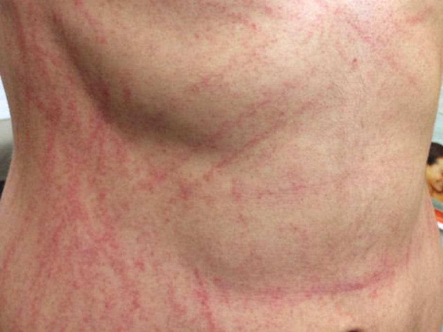 shiitake flagellate erythema
