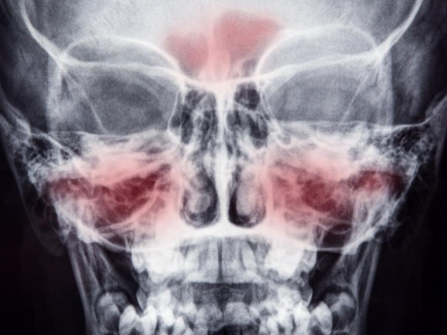 sinusitis