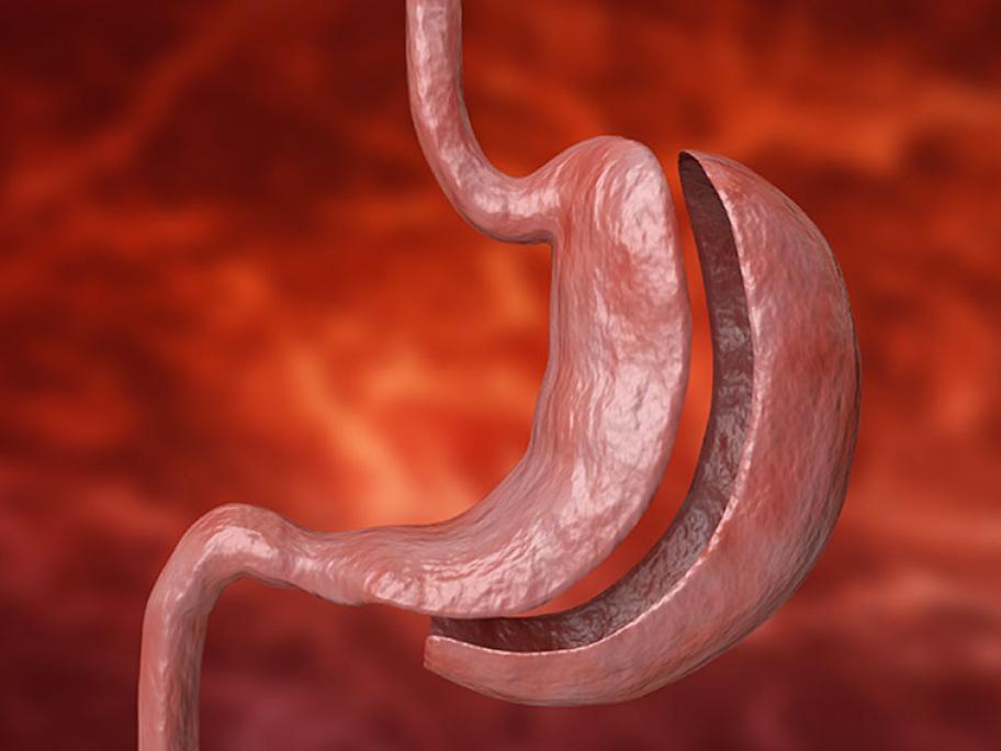 Sleeve gastrectomy