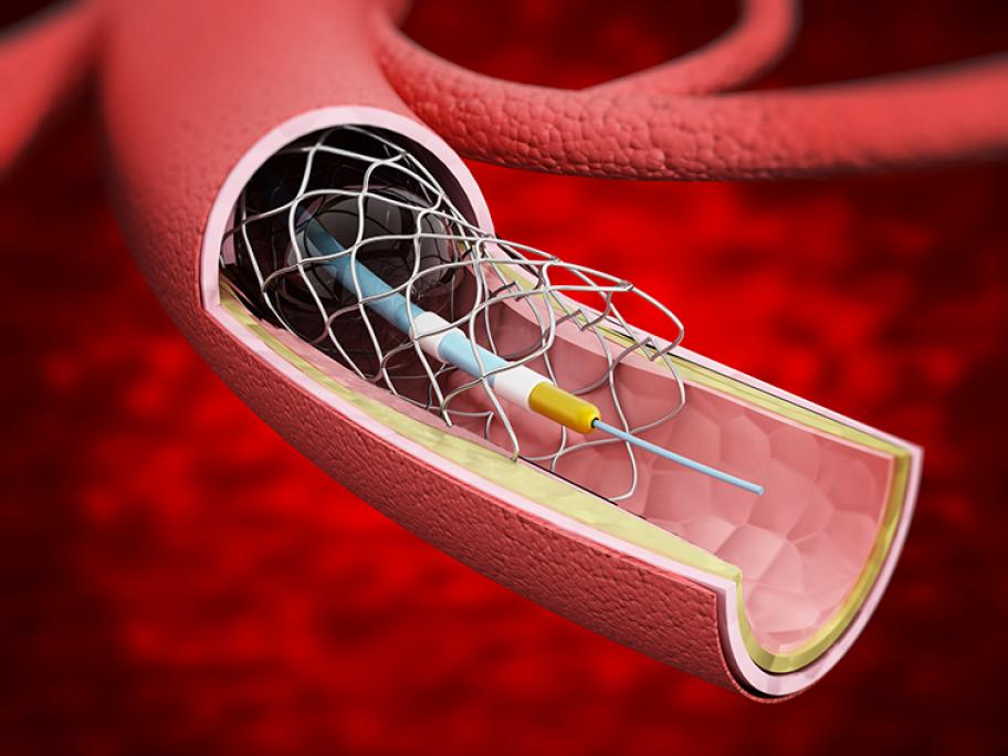 stent