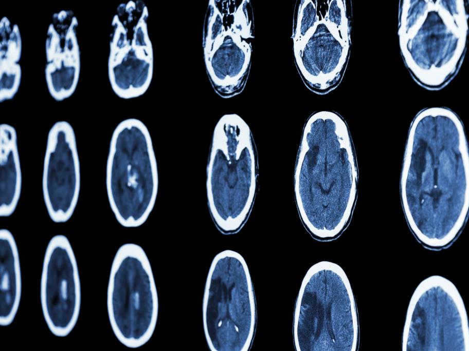 stroke - brain MRI