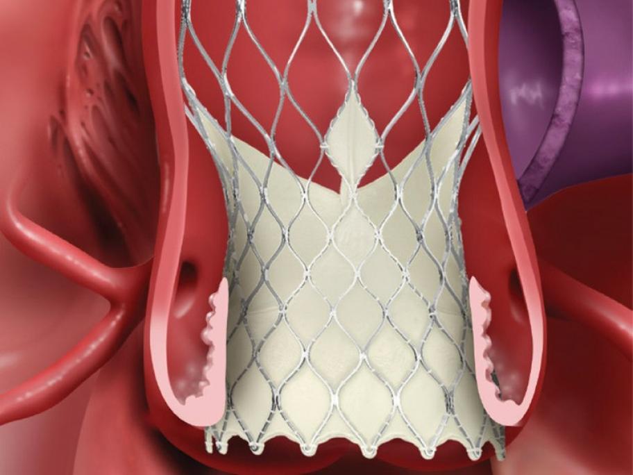Medtronic Evolut R valve