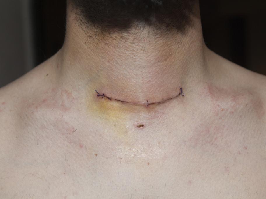 Thyroidectomy scar