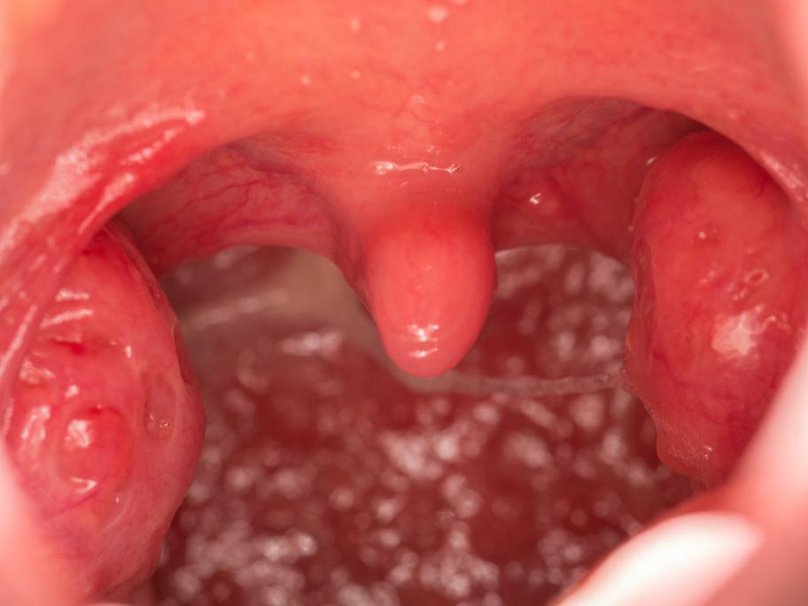 Tonsils