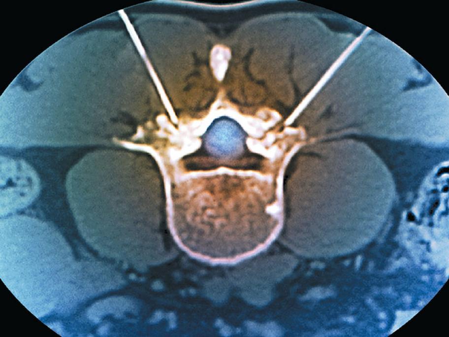 Spondylolysis treatment ct scan