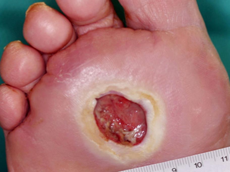 Diabetes-related foot ulcer.