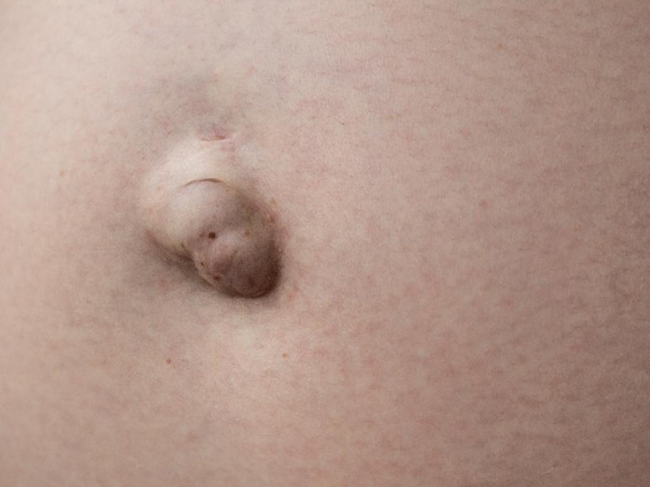 umbilial hernia in female