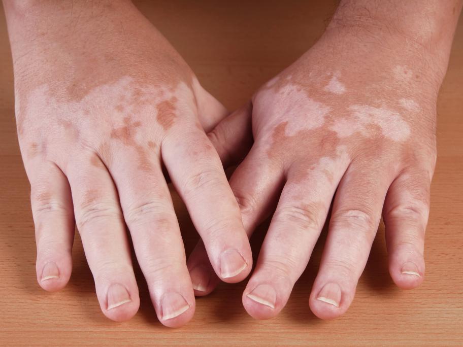 vitiligo