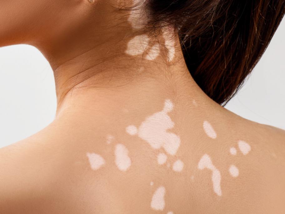 Young woman with vitiligo patches on her back