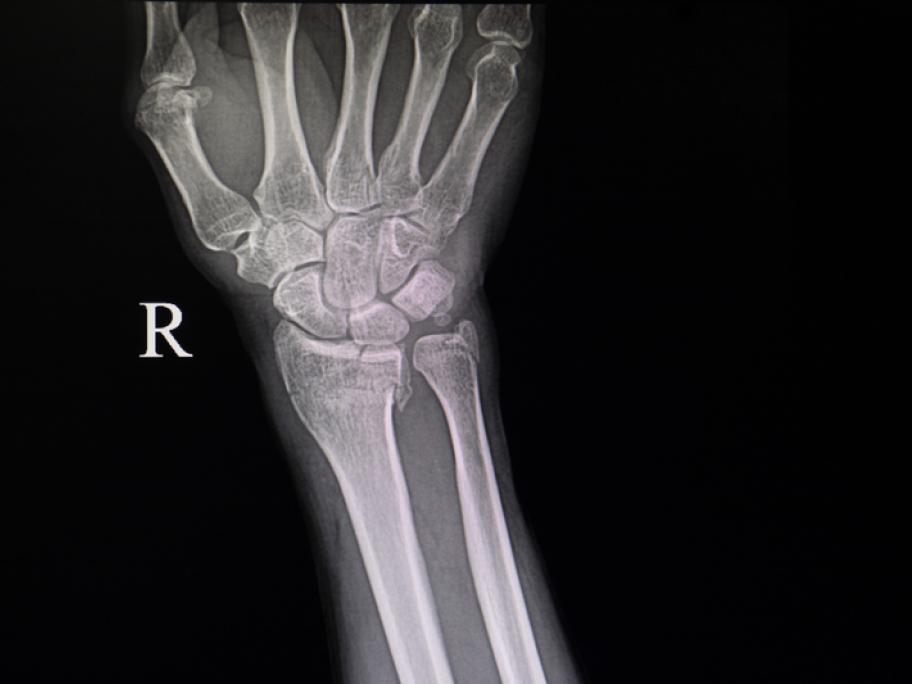 Wrist fracture