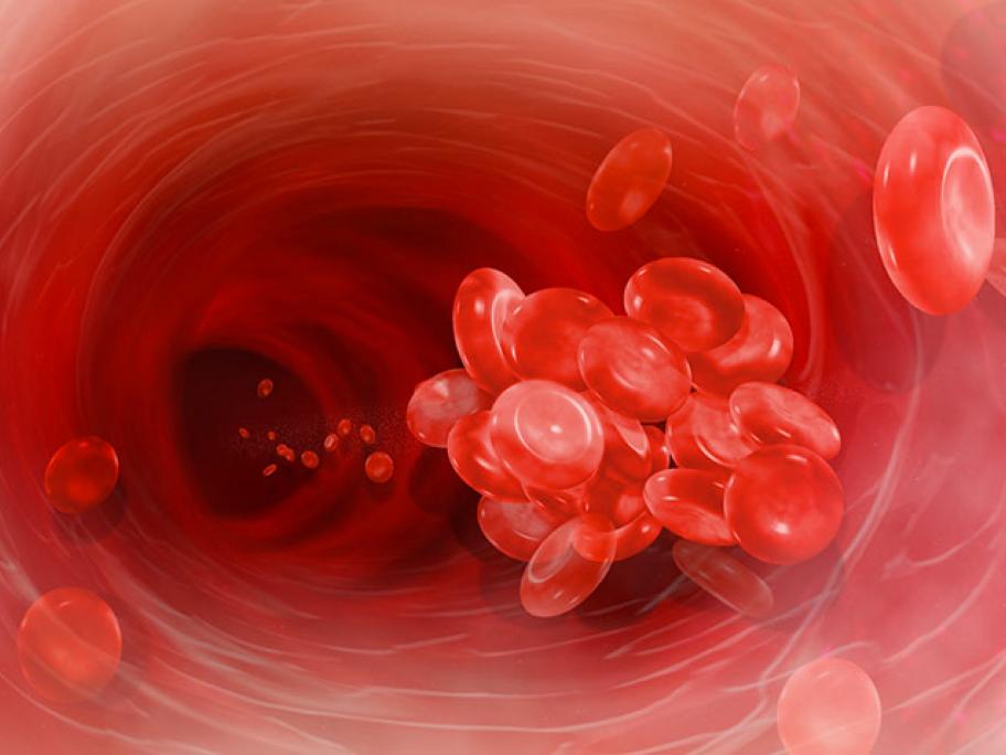 blood clot