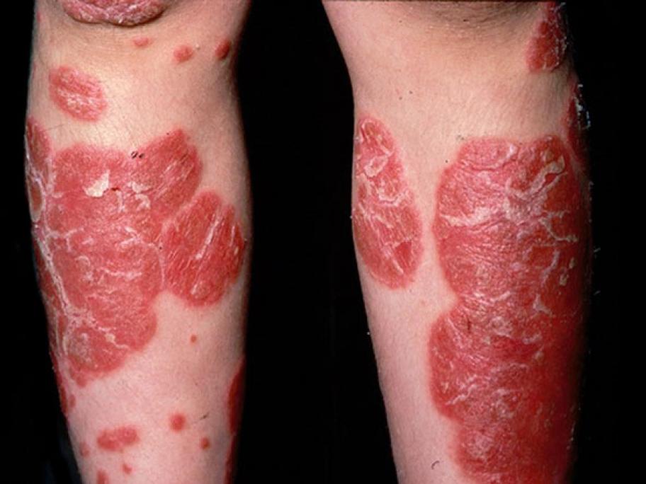 Psoriasis