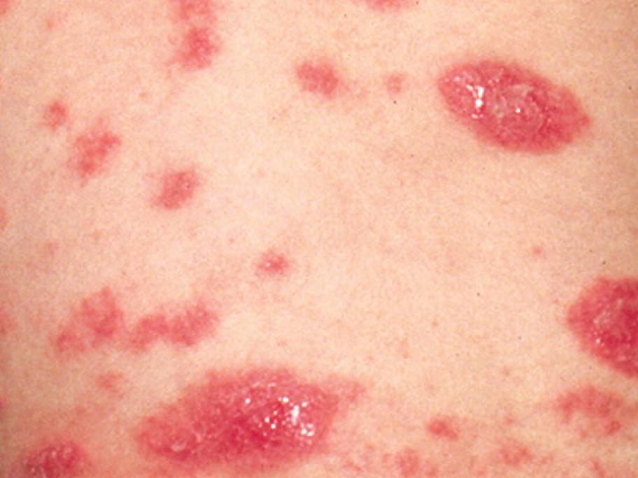 Discoid eczema