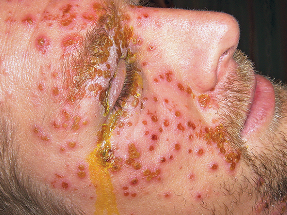 Treating Eczema Herpeticum Australian Doctor Group Treating Eczema Herpeticum Australian Doctor Group