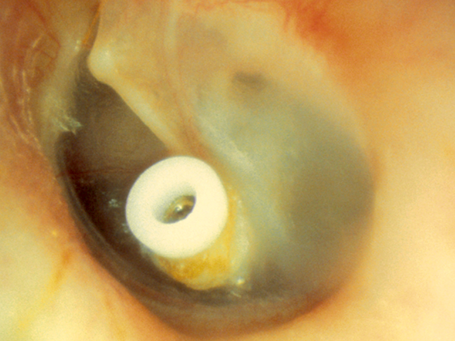 otitis media