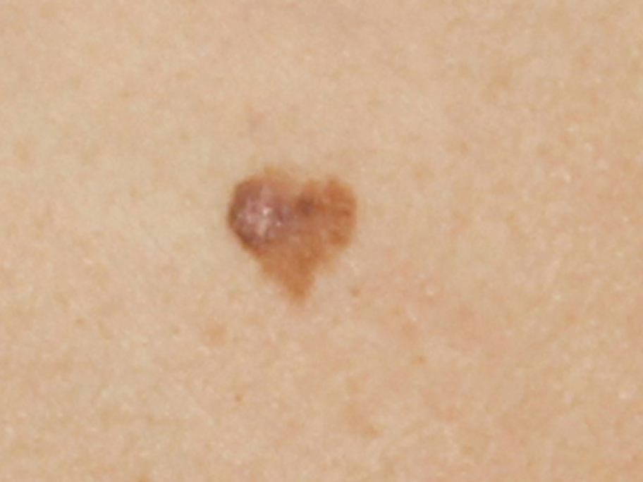 heart-shaped lesion