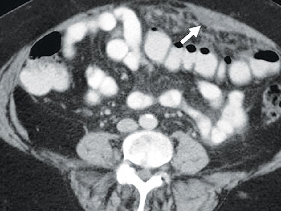 Figure 1. CT abdomen demonstrating loculated ascitic fluid (arrow) anterior to the omentum. 