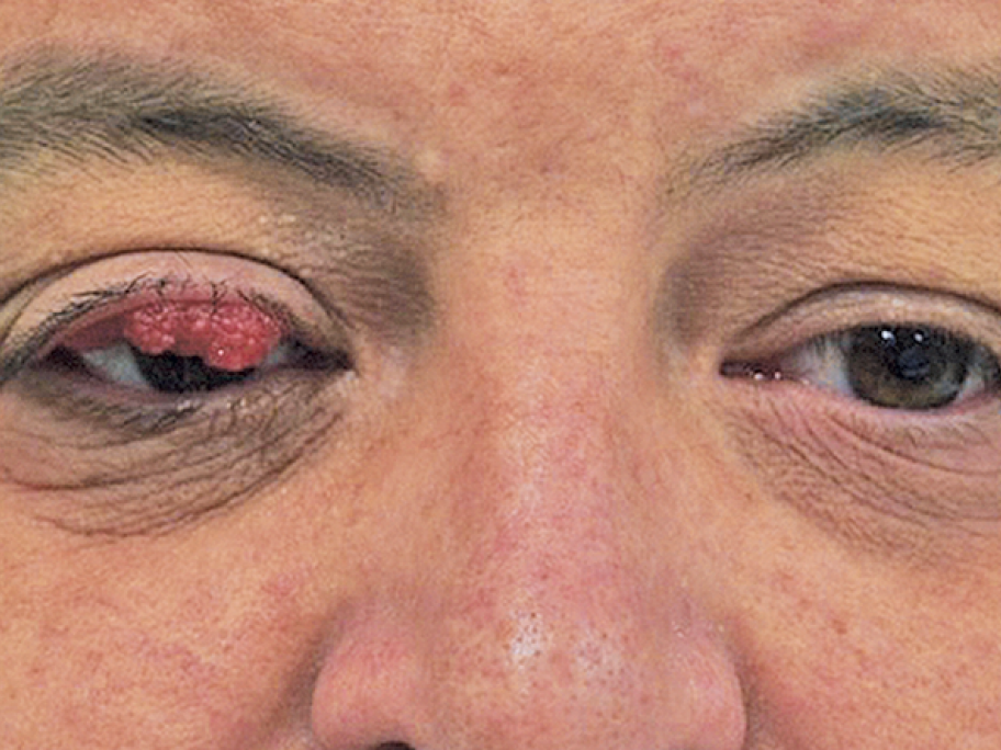 floppy eyelid