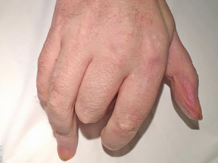 CRPS