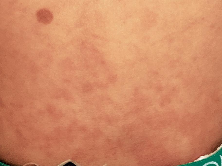 maculopapular-rash
