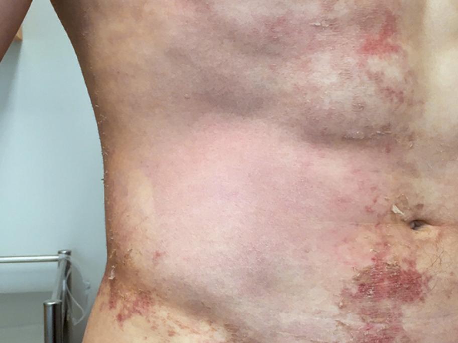 desquamation_resolving-erythema