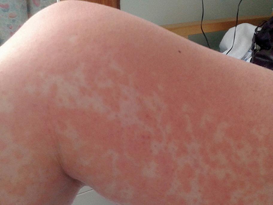 Rash
