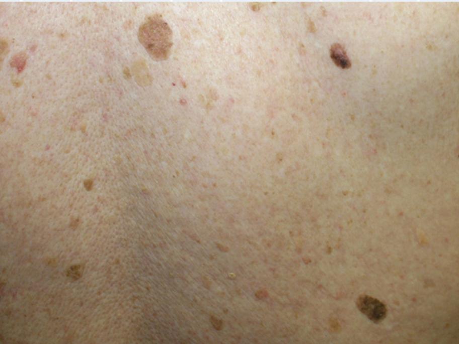melanoma