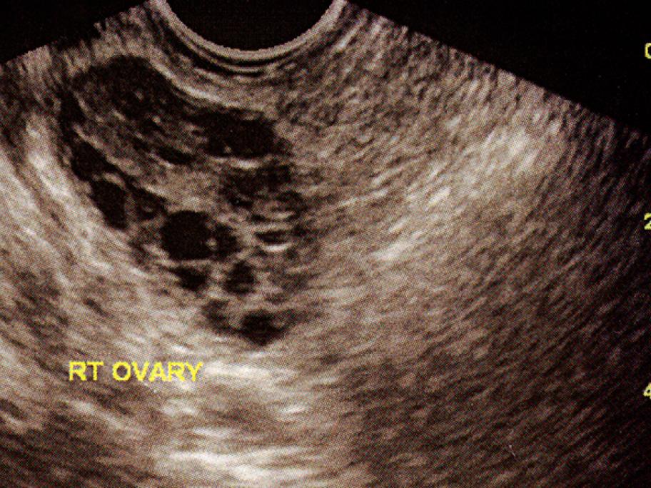 PCOS