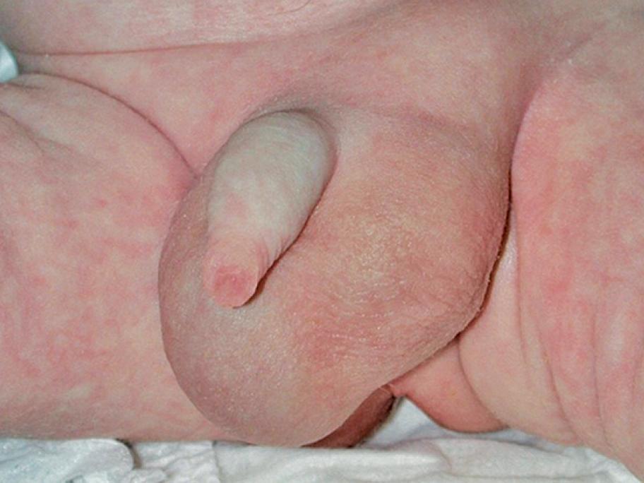 hydrocele