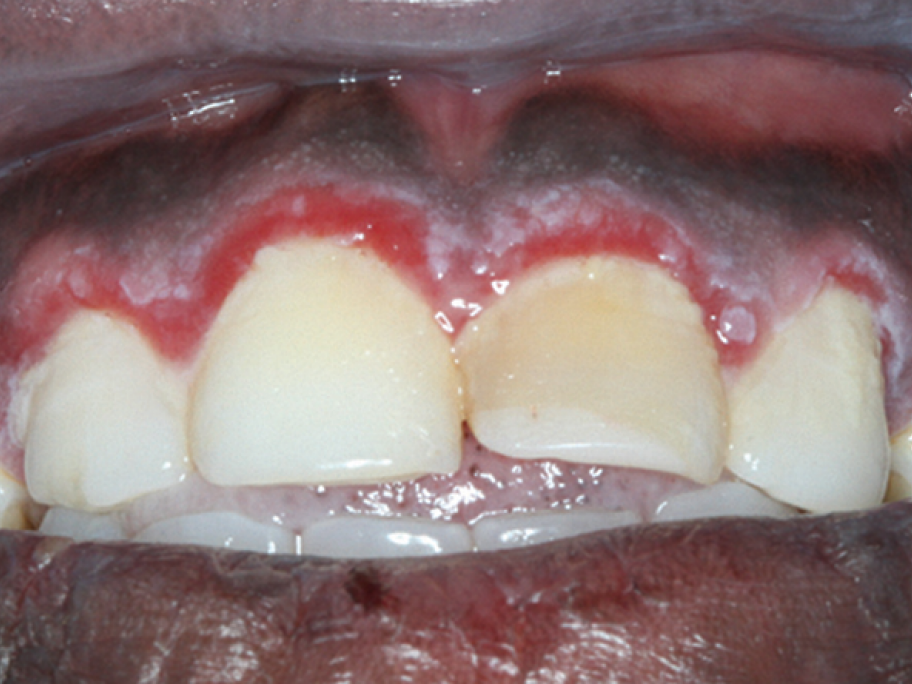 bleeding gums