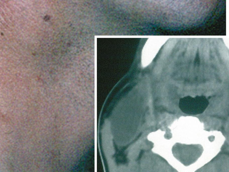 branchial cyst