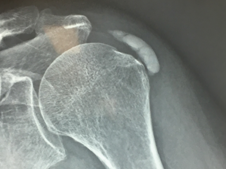 calcific tendinitis