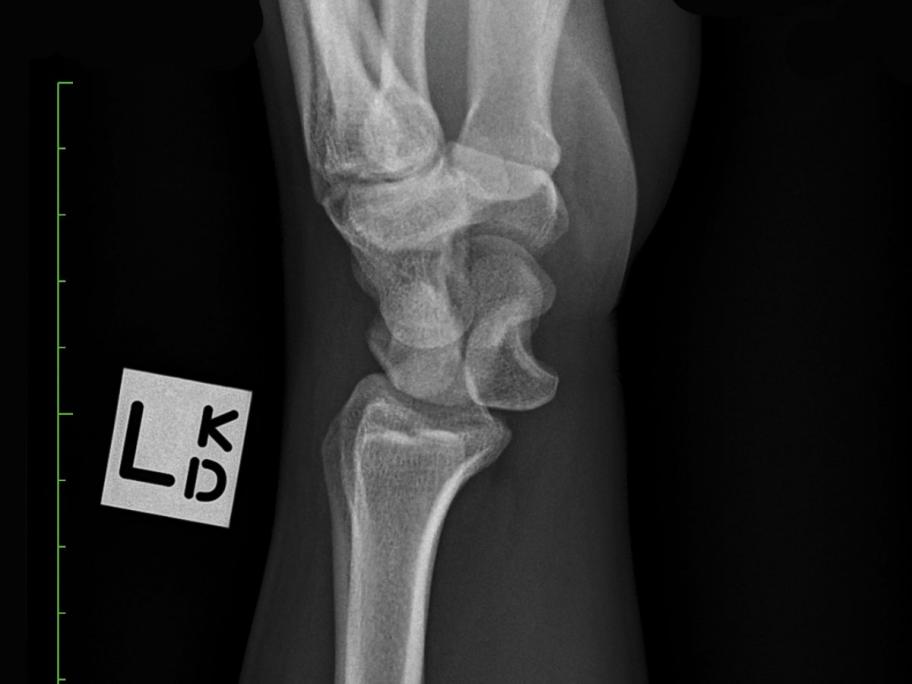 carpal tunnel