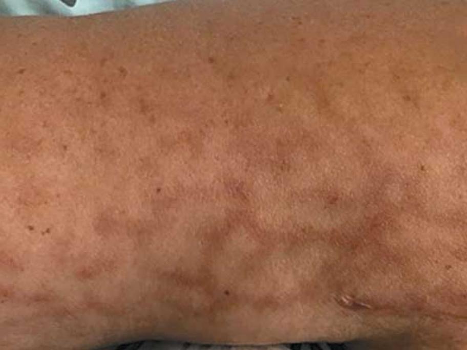 erythema