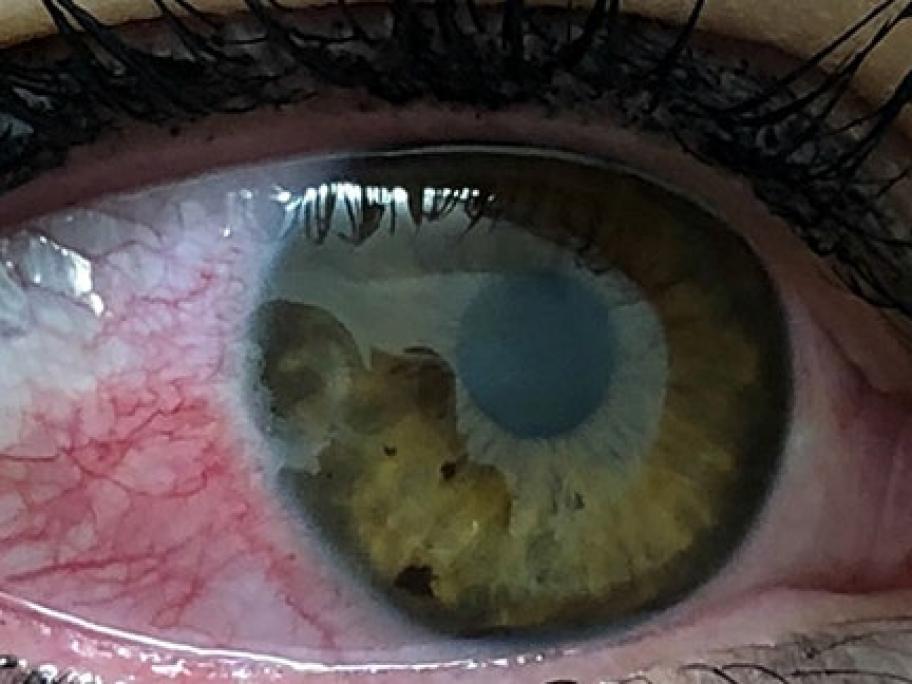 ulceration