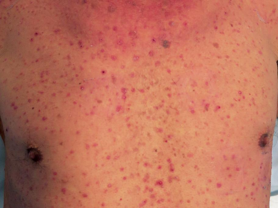 hepatitis b