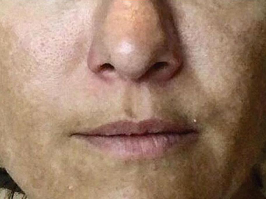 melasma