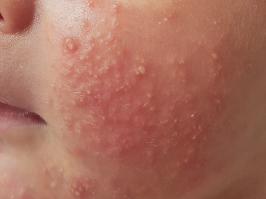 rash