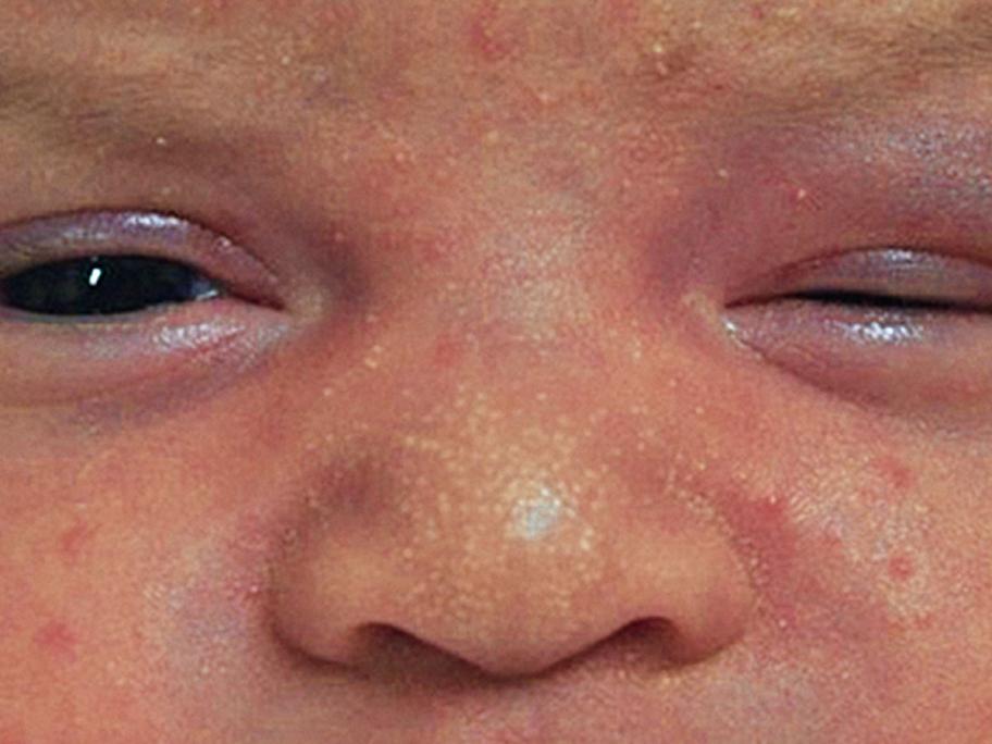 ptosis