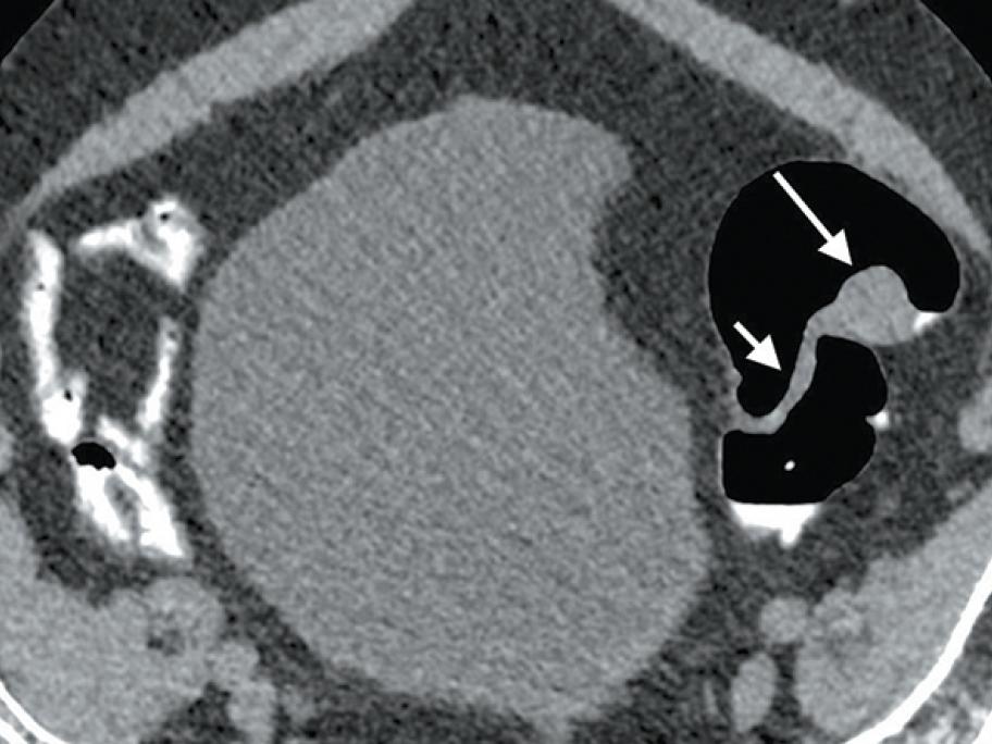 panel a ctc polyp supine tomsutherland