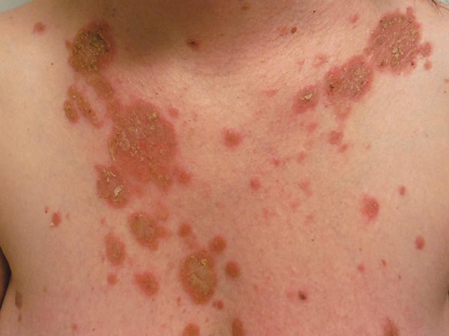 pemphigus foliaceus