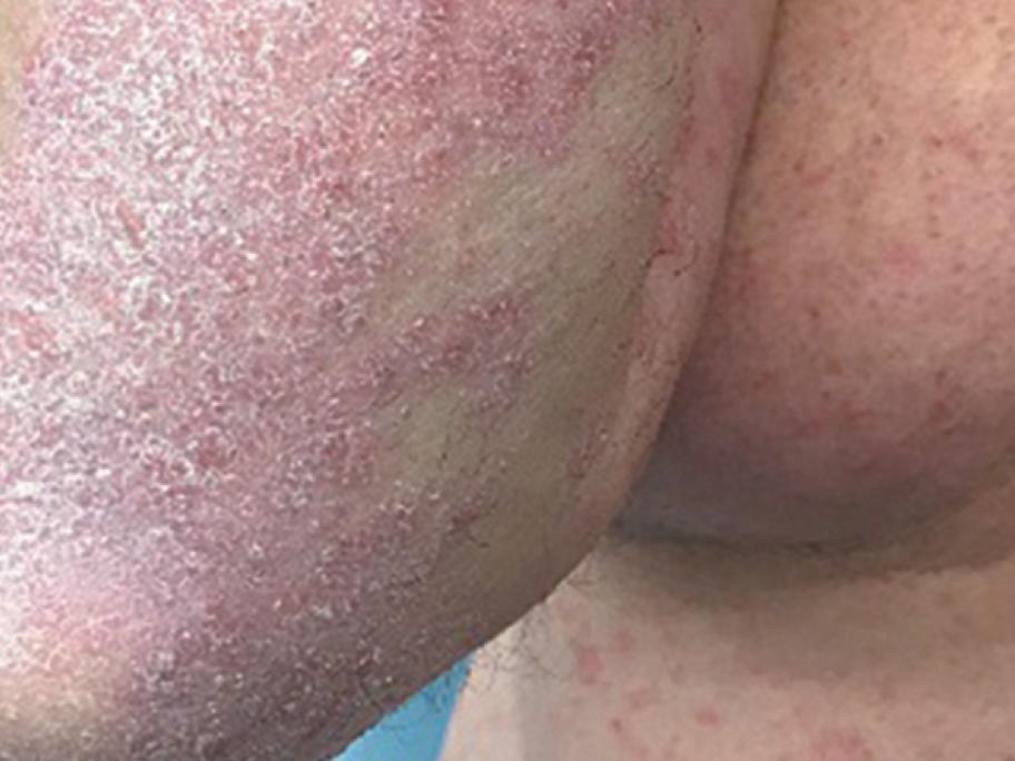psoriasis