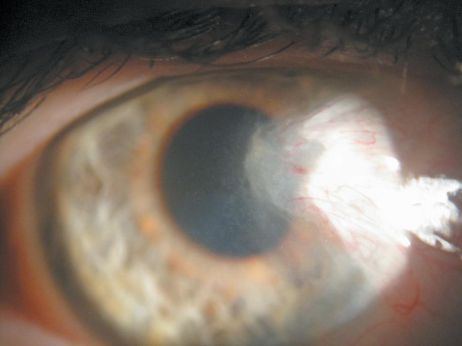 pterygium