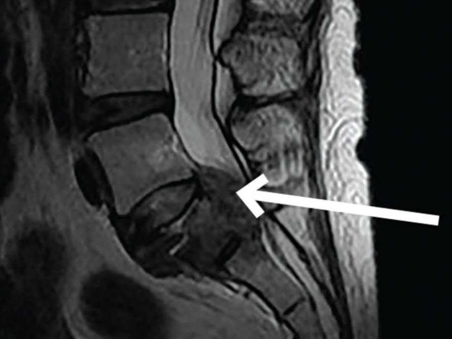 sacral tumour
