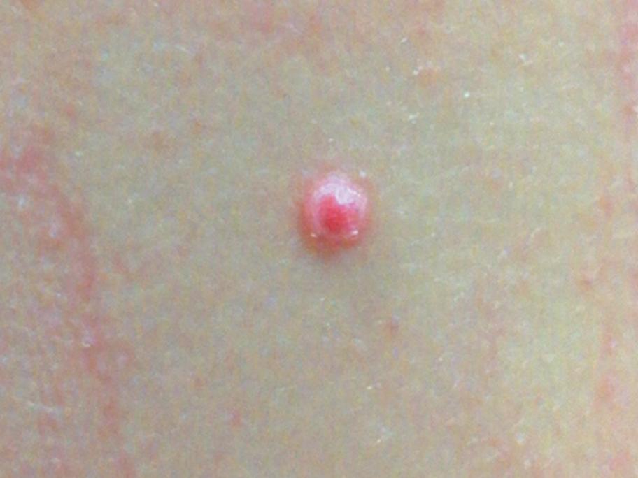 Quiz spitz nevus