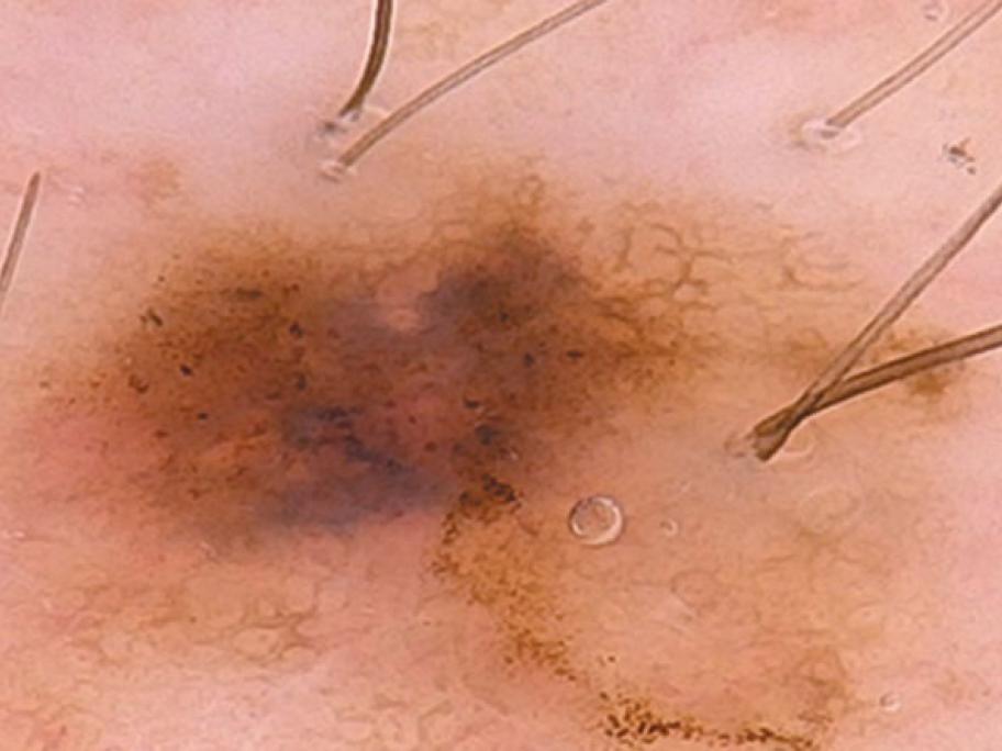 melanoma in situ