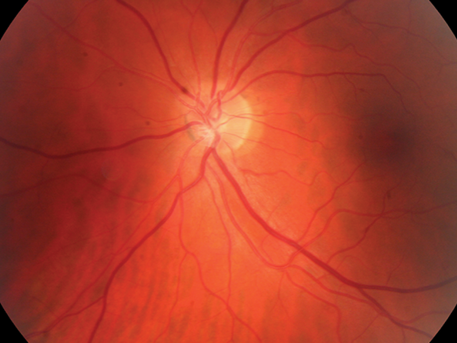 syphilitic eye
