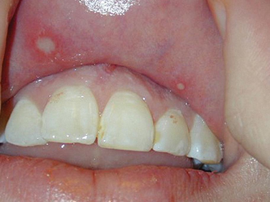 behcets-disease-figure-1