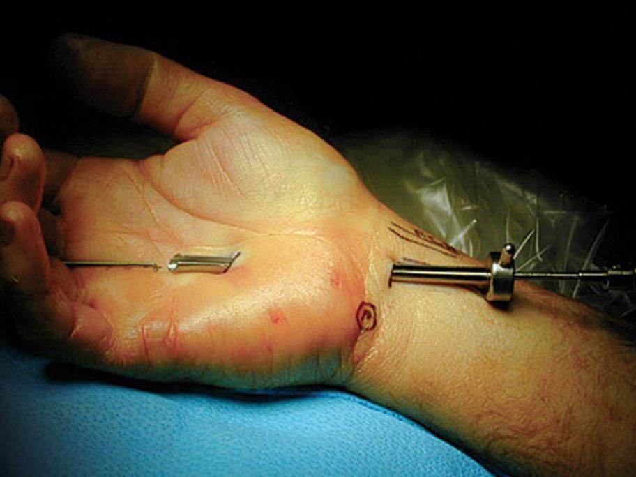 carpal tunnel